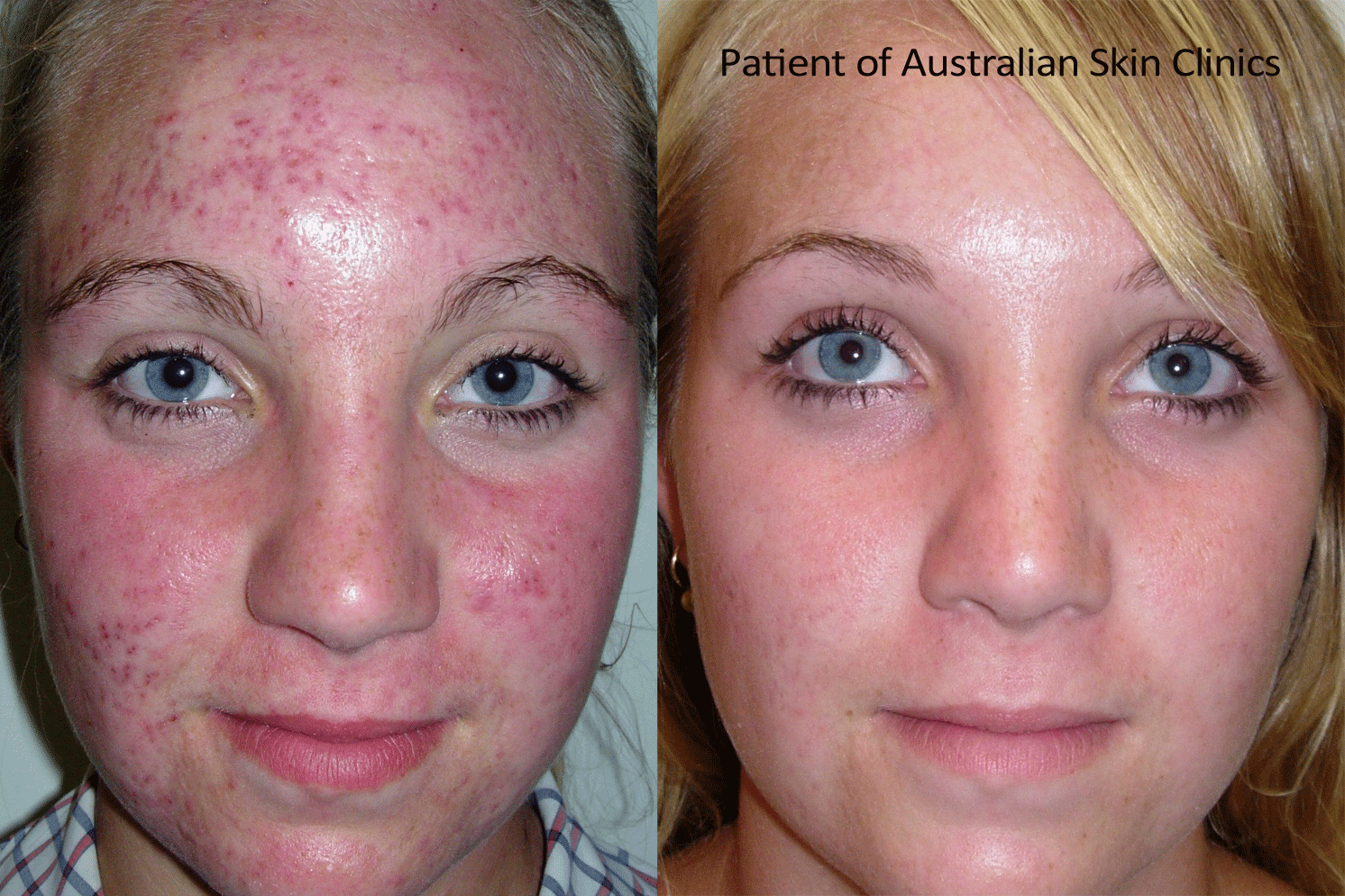 Acne Scars Before After